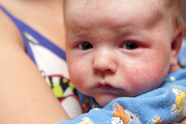 身上長濕疹怎么辦？得了濕疹，需
